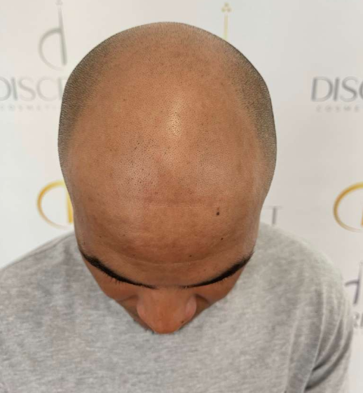 Vitamin D3 treatment image