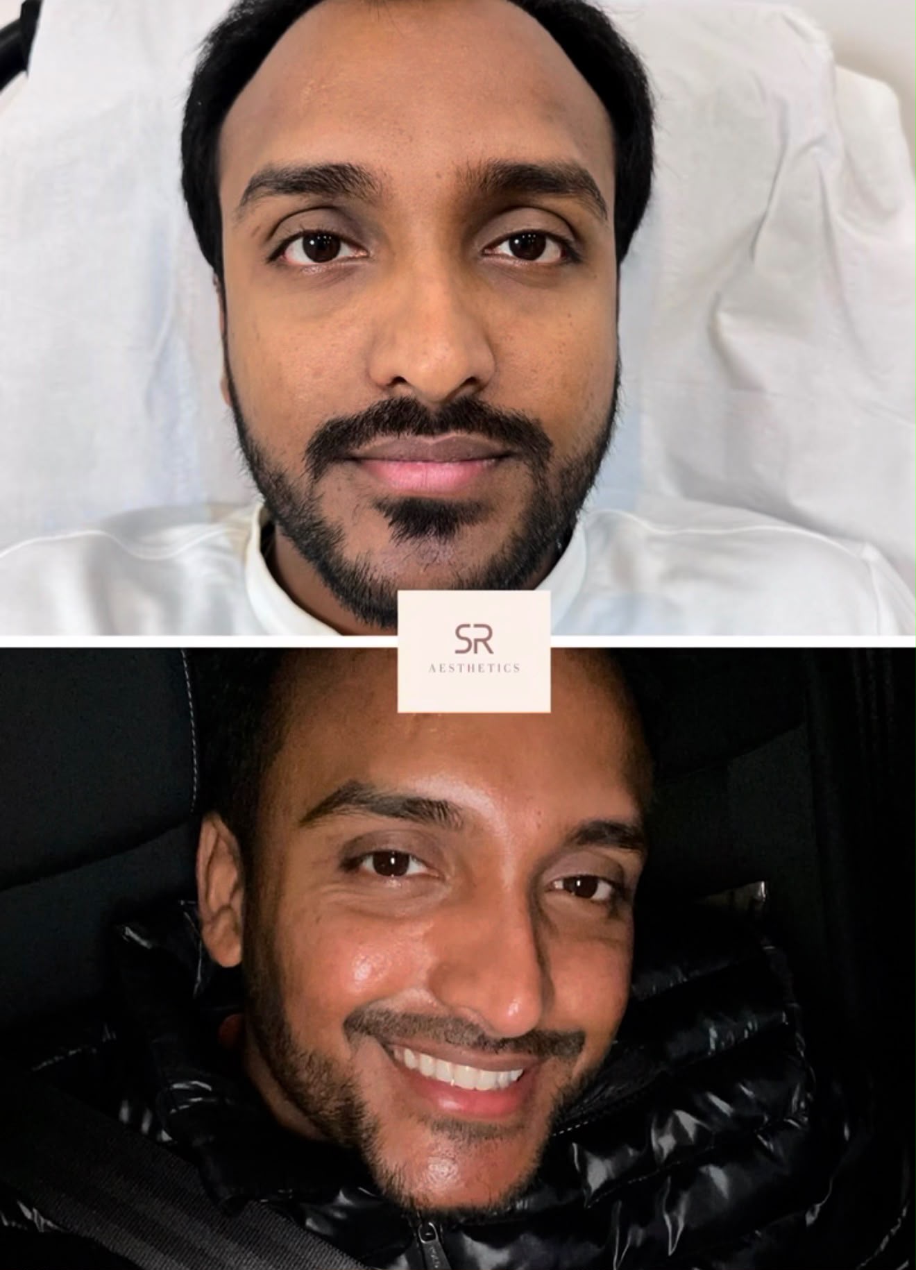 Before and after results from a treatment at SR Aesthetics