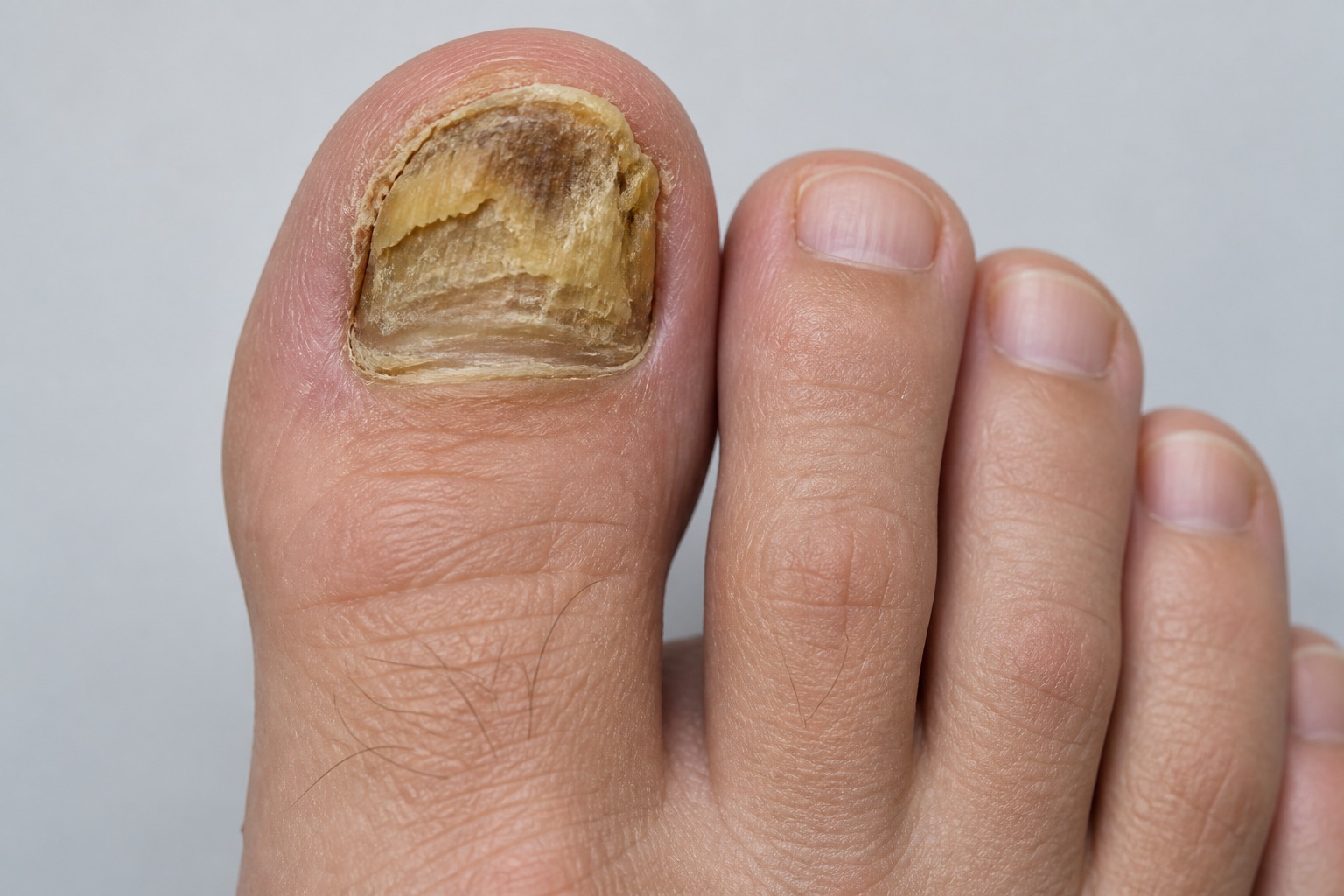 Uña muy engrosada, amarilla y deshecha en capas, propia de la onicomicosis distrófica total