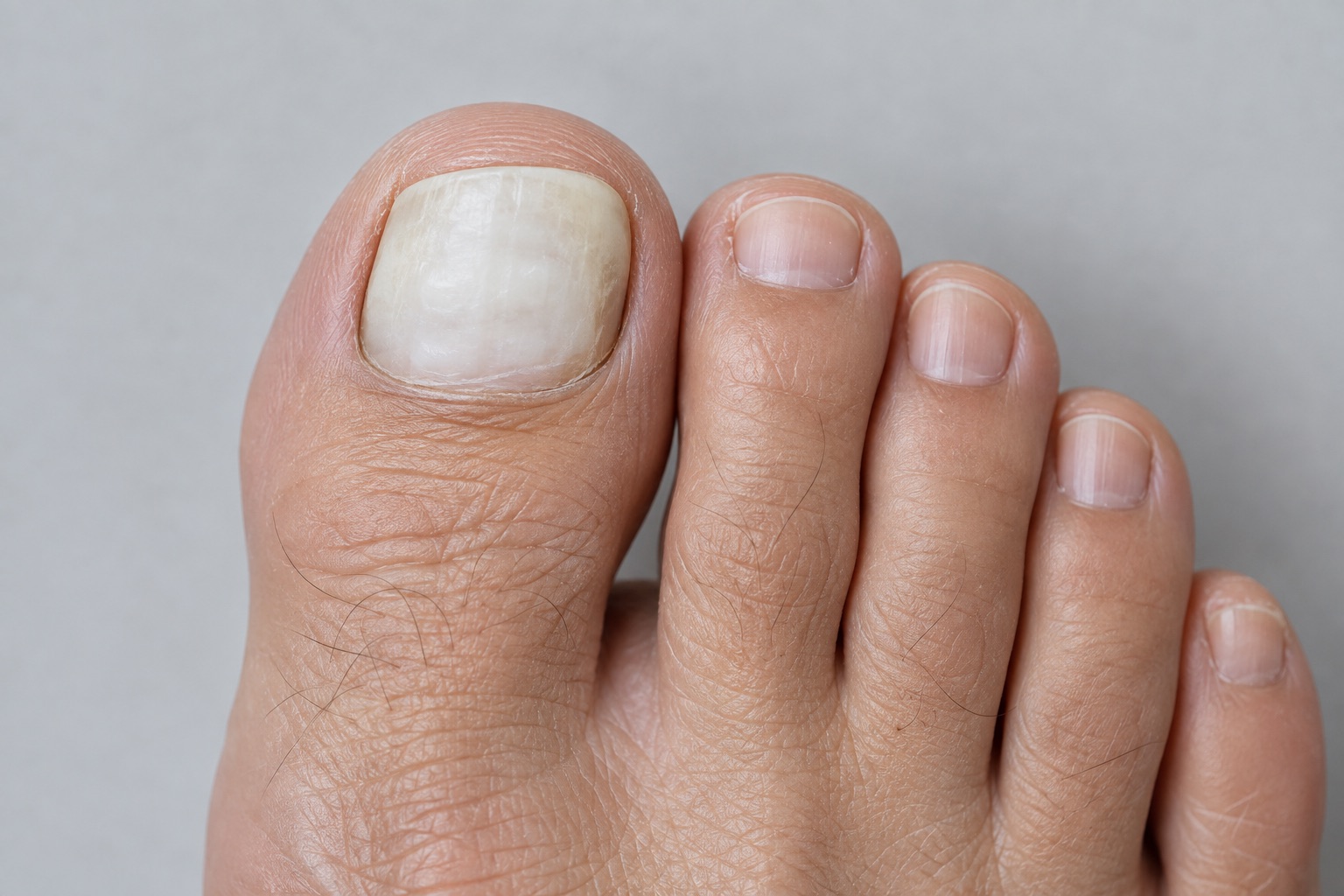 Uña de aspecto lechoso y opaco con la superficie lisa, propia de la onicomicosis tipo endonix
