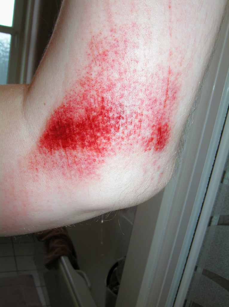 A bruised elbow from a dog-walking fall