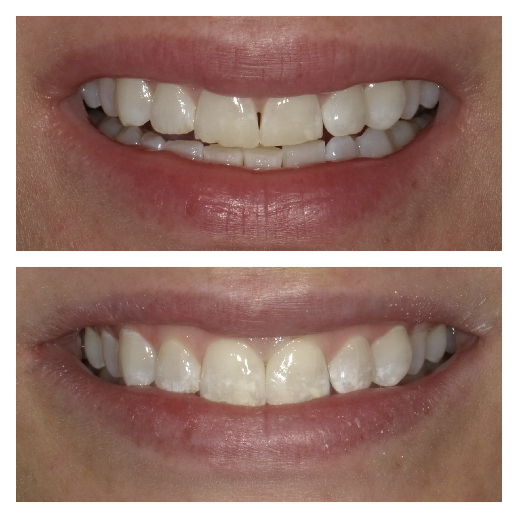 Smile Transformation 15