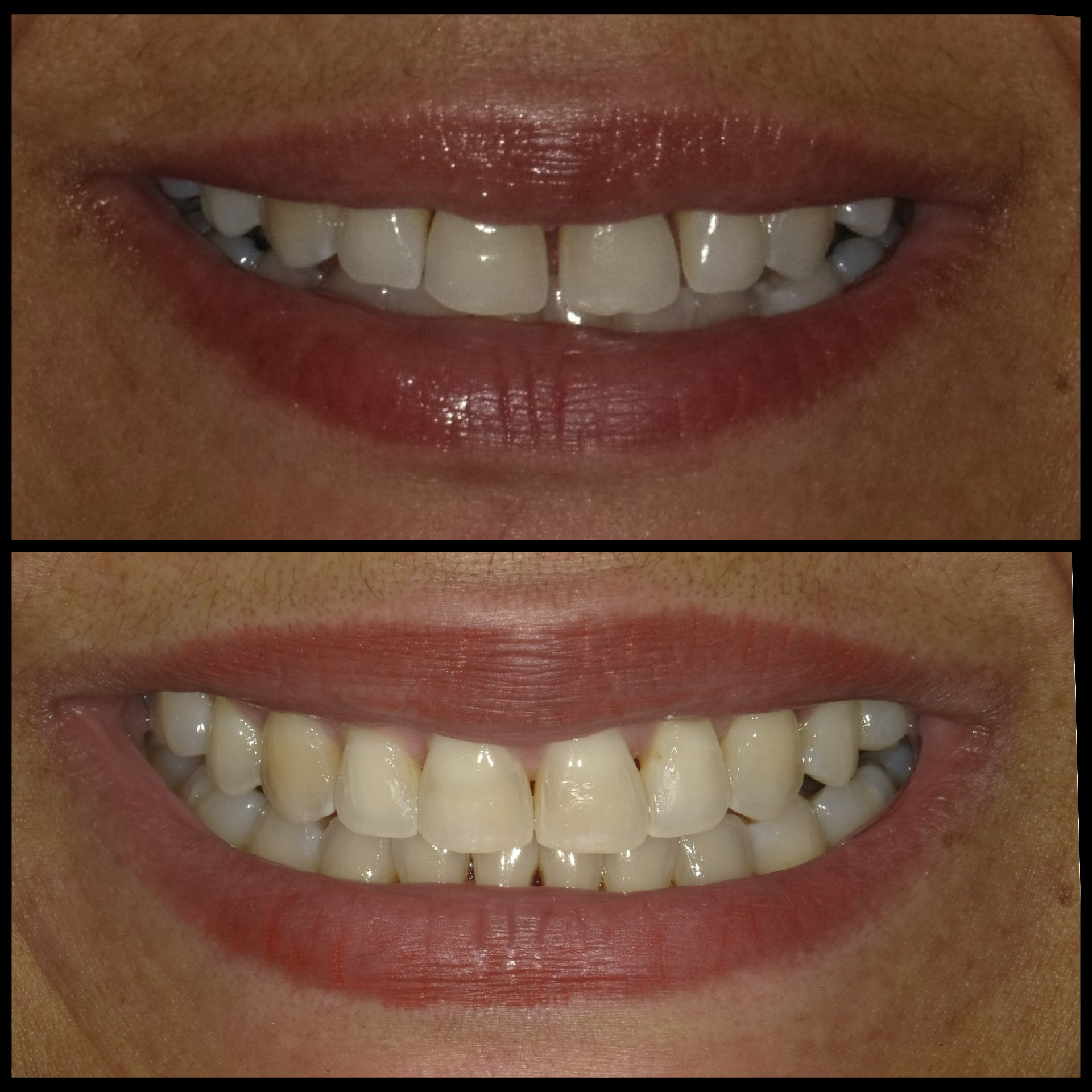 Smile Transformation 16