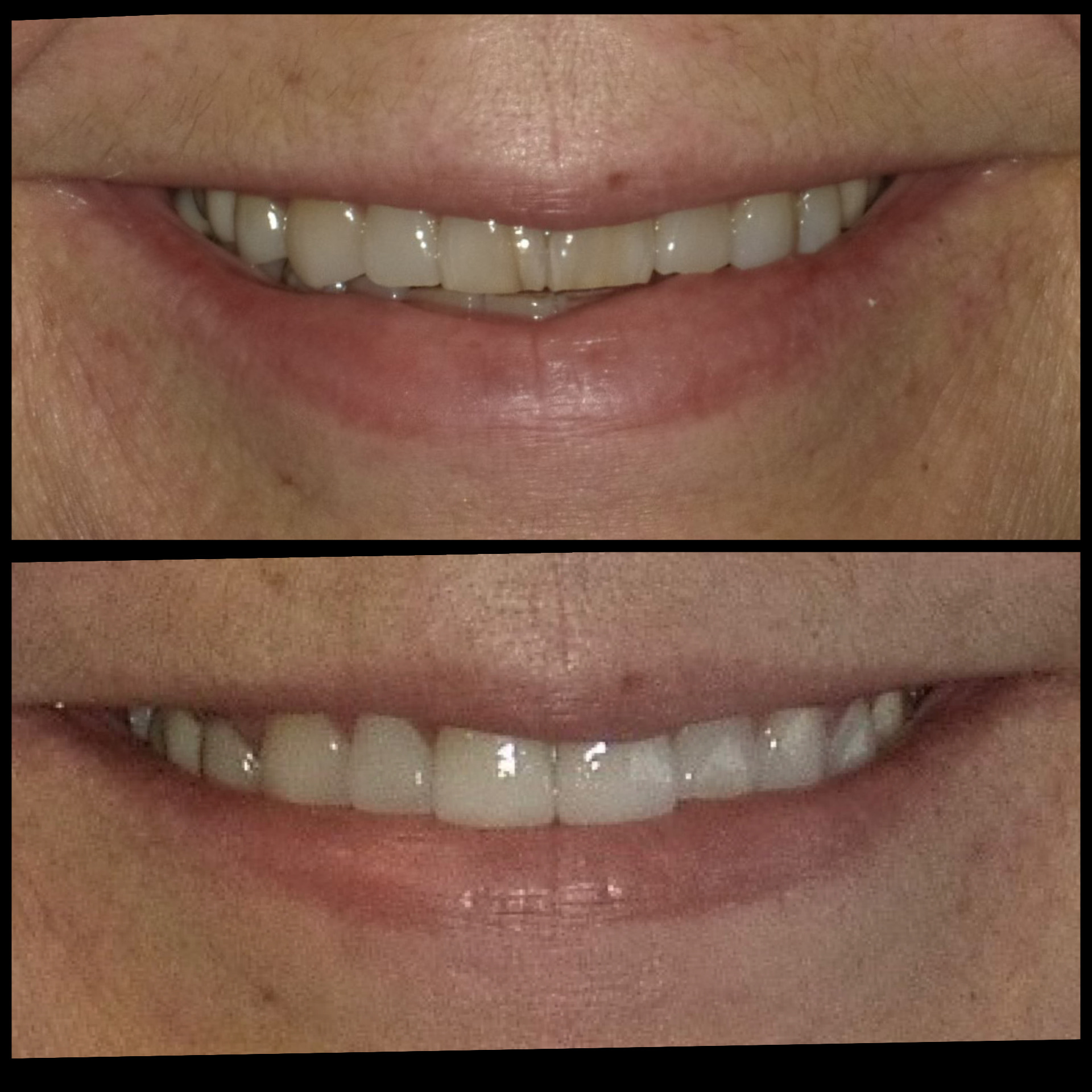 Smile Transformation 17