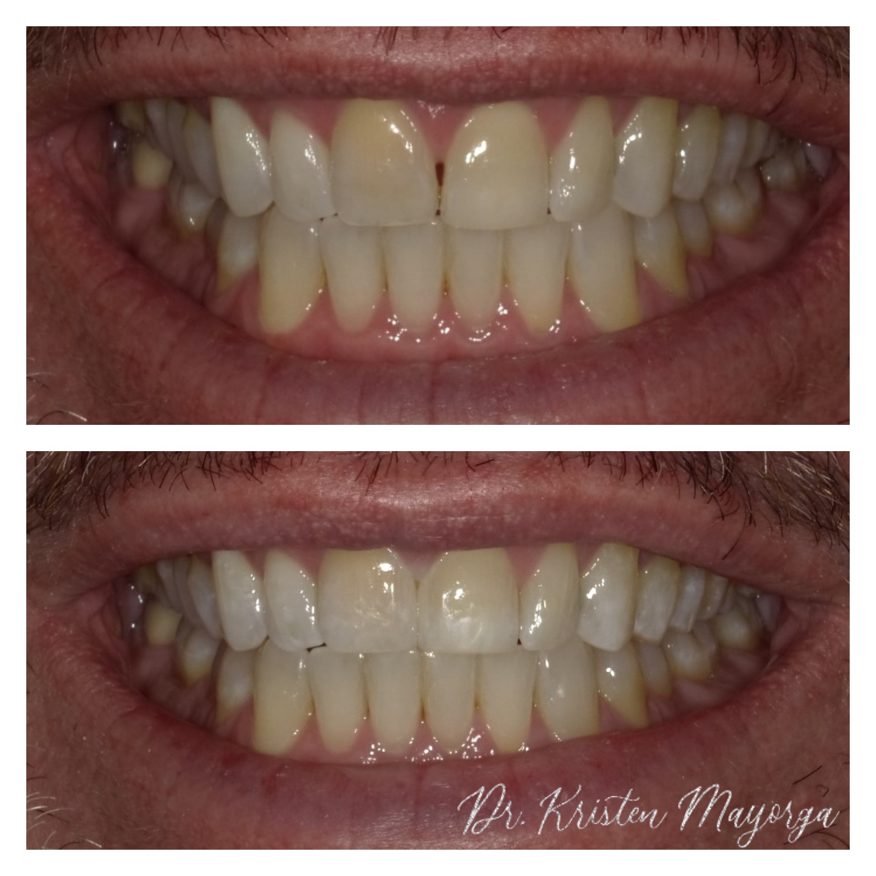 Smile Transformation 11