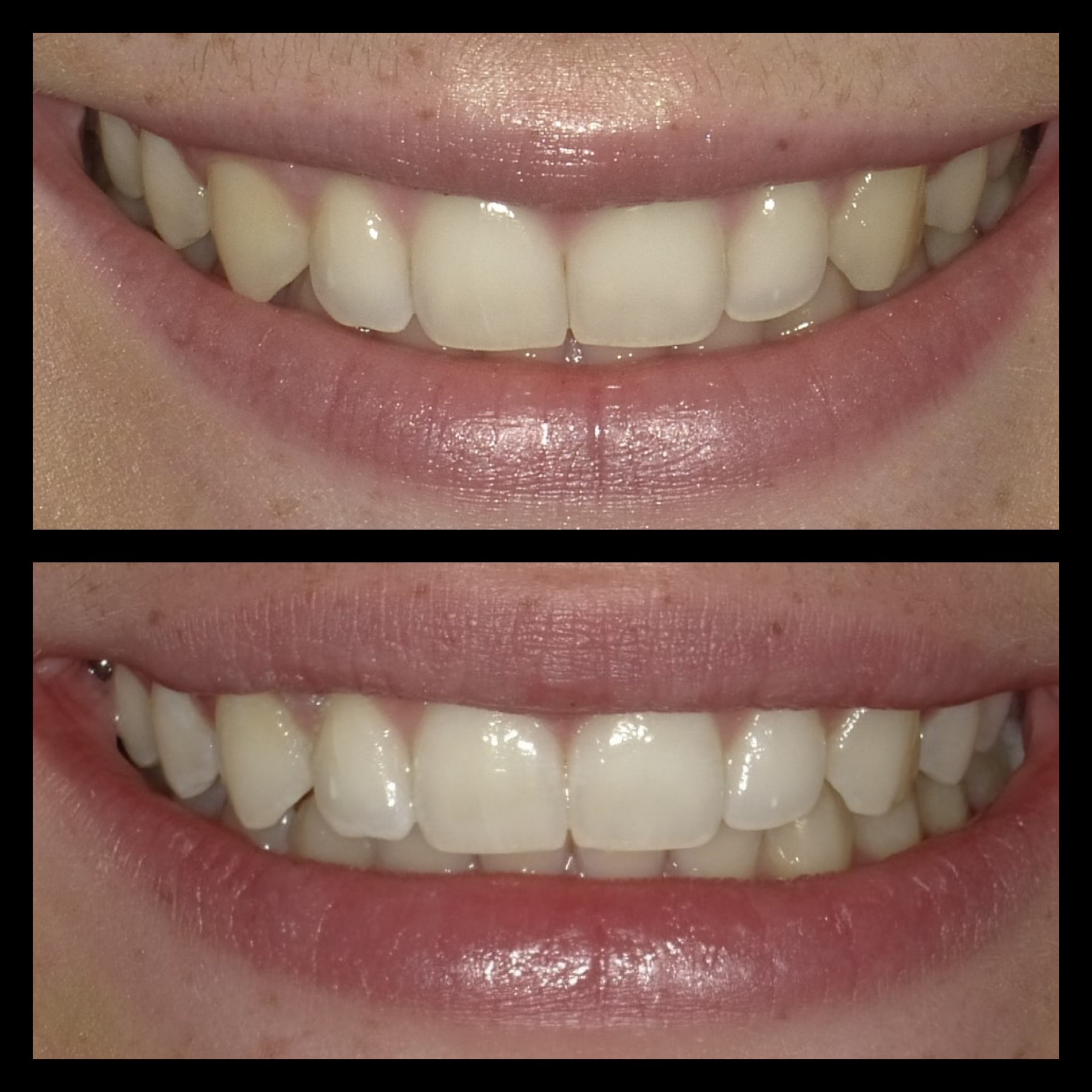 Smile Transformation 12