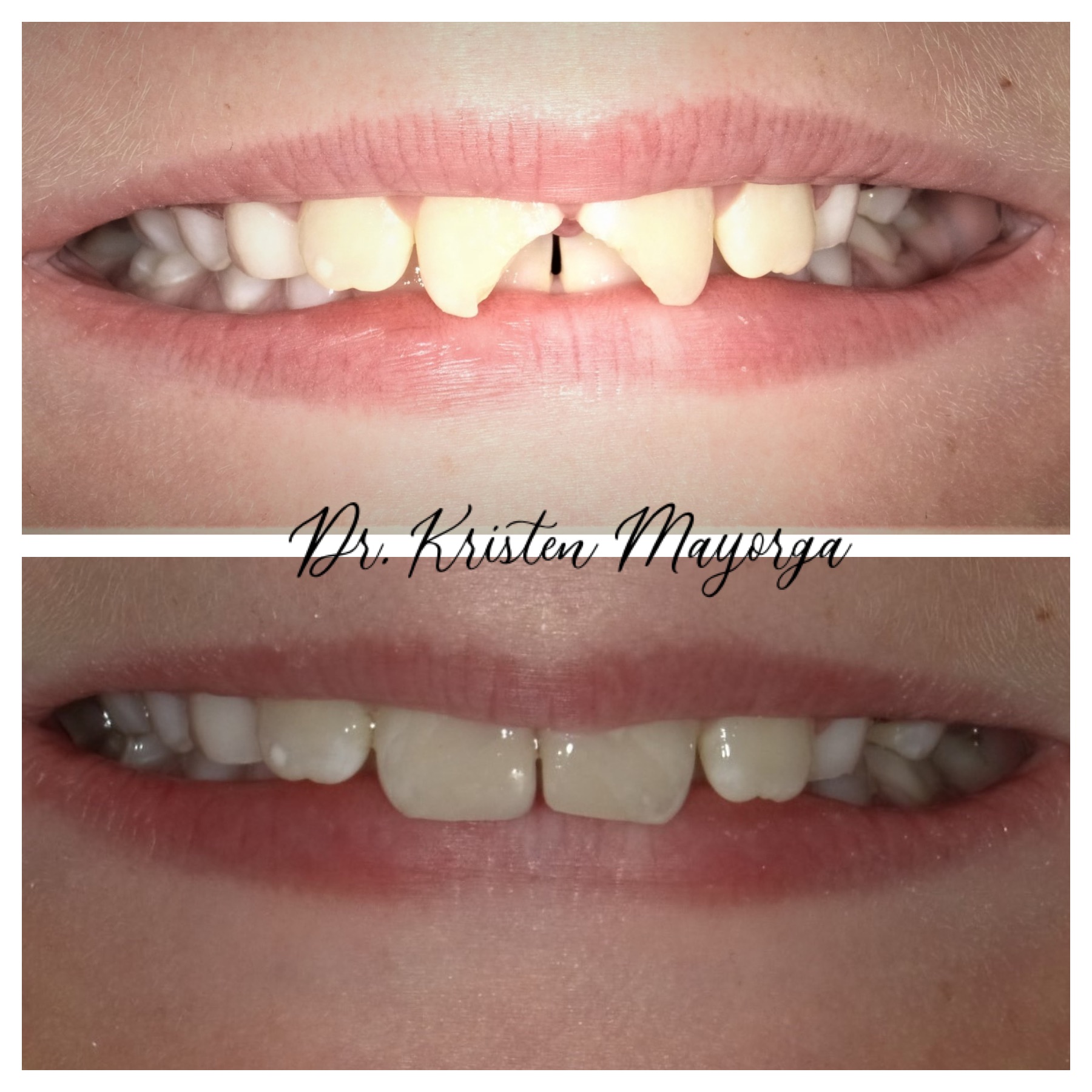 Smile Transformation 20