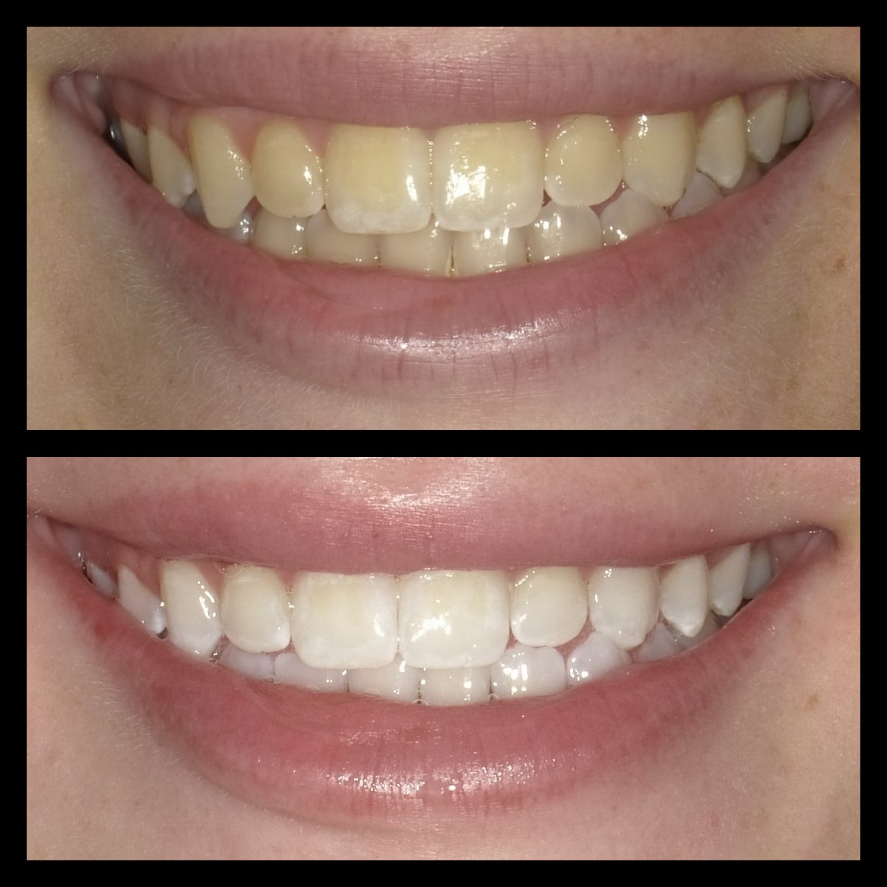 Smile Transformation 9