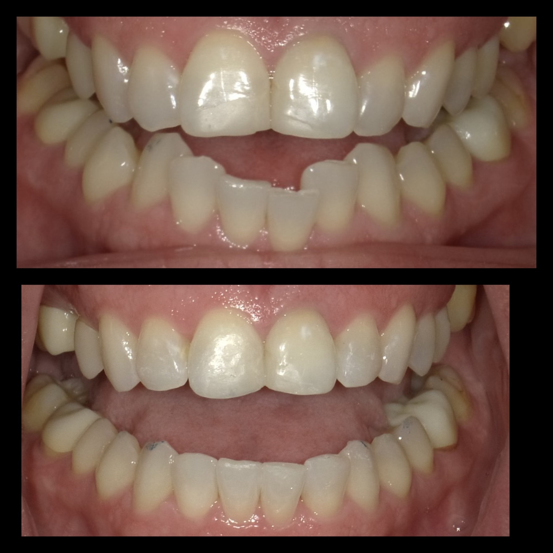 Smile Transformation 8