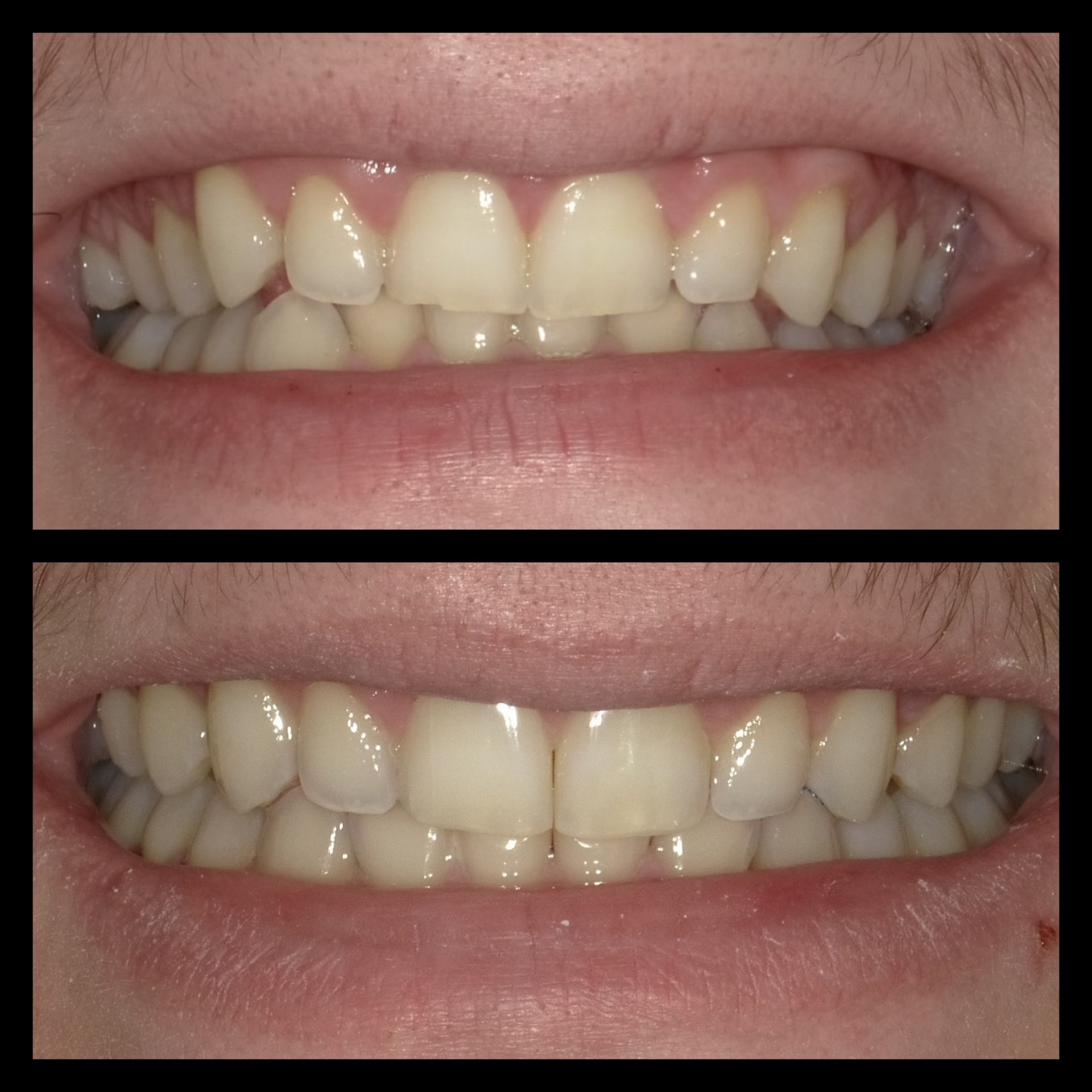 Smile Transformation 4
