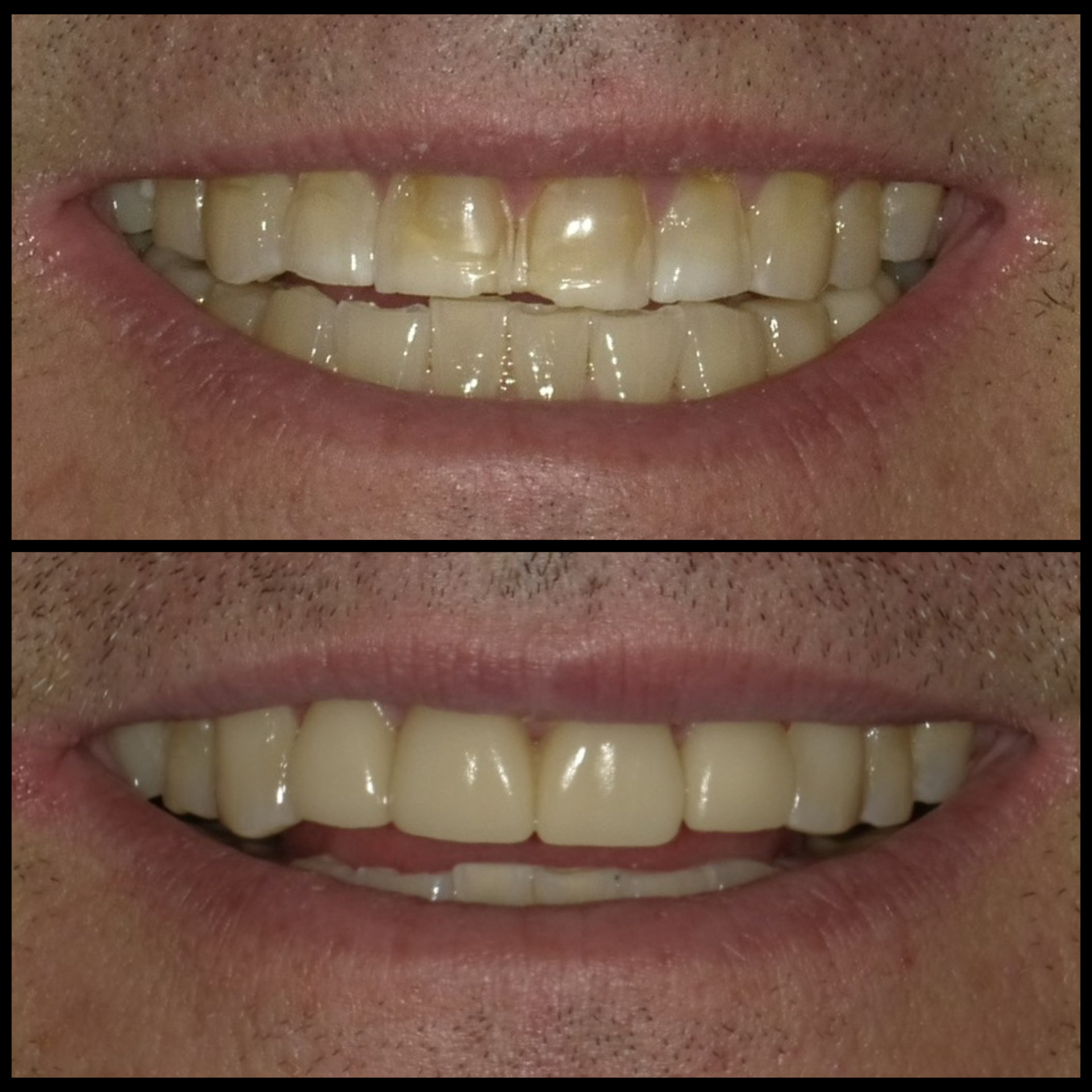 Smile Transformation 5