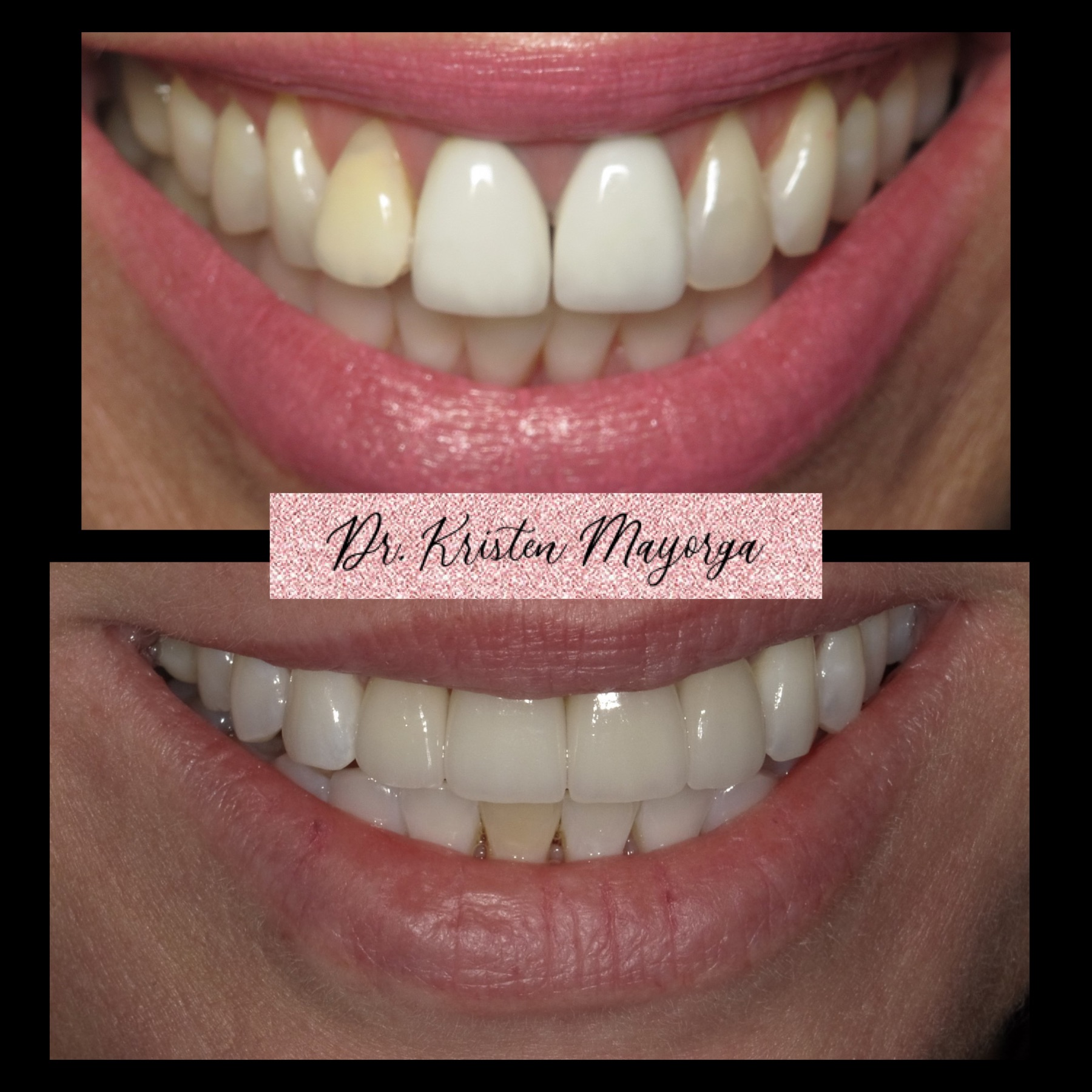 Smile Transformation 2