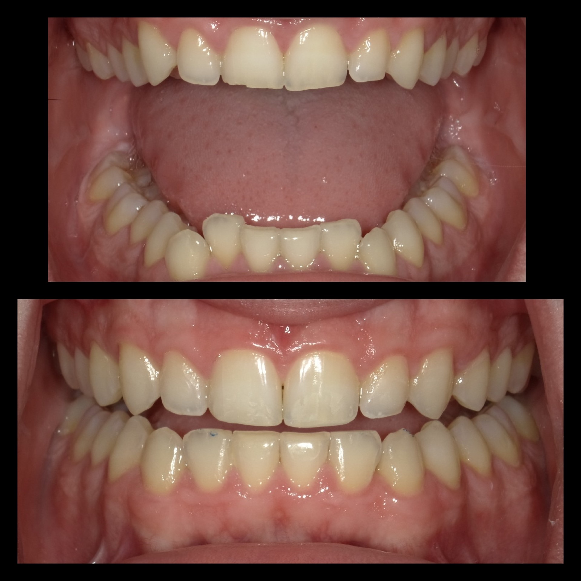 Smile Transformation 6