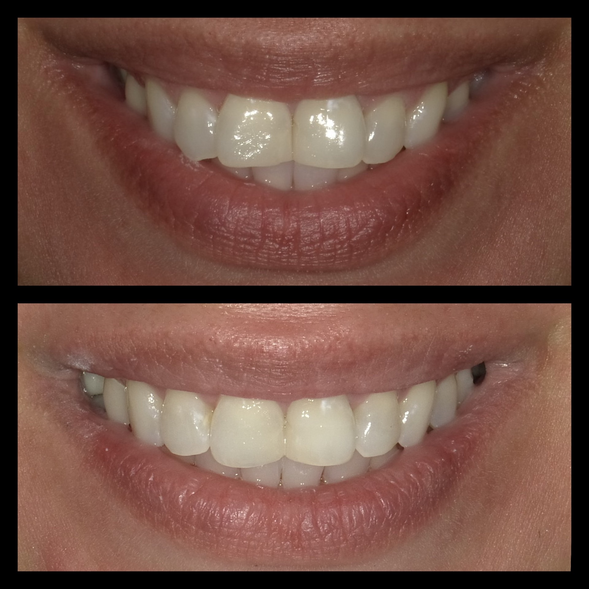 Smile Transformation 7