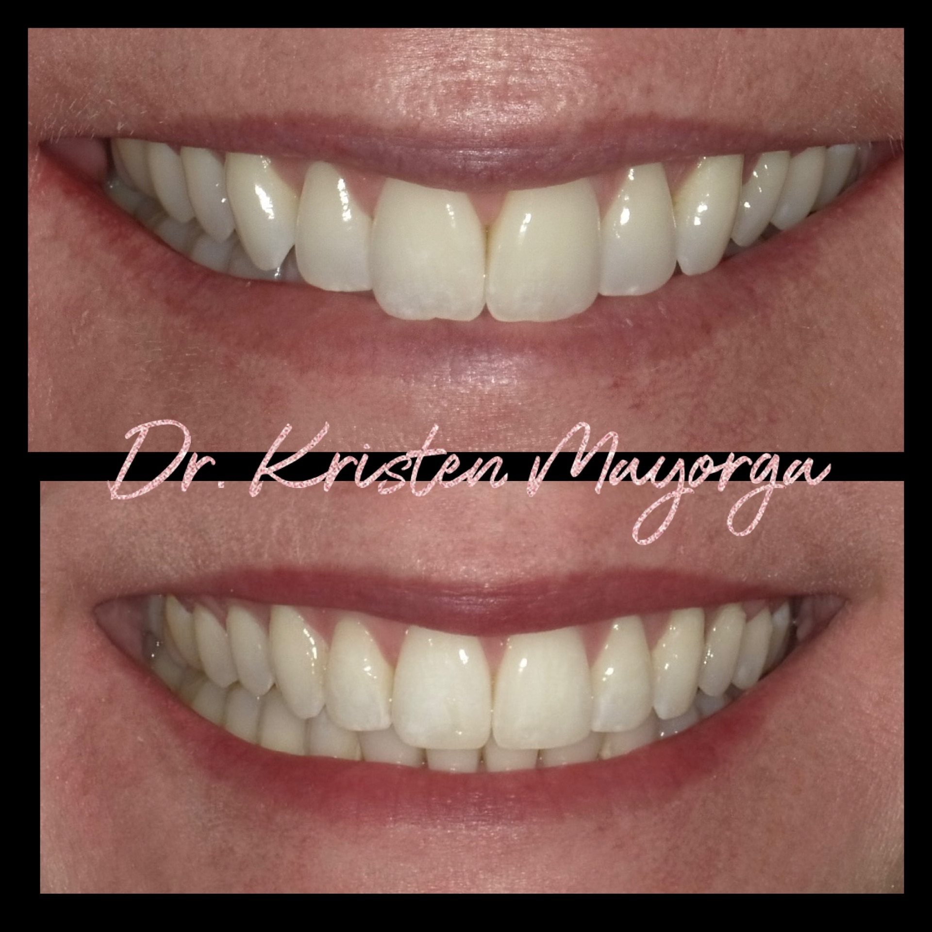 Smile Transformation 3