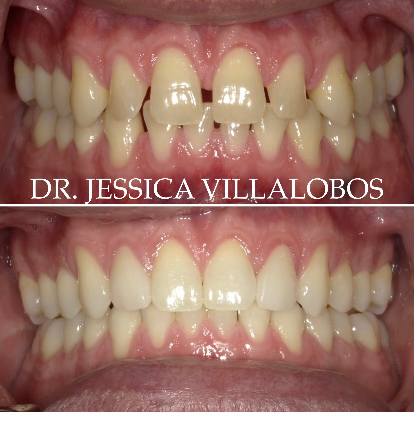 Smile Transformation 1