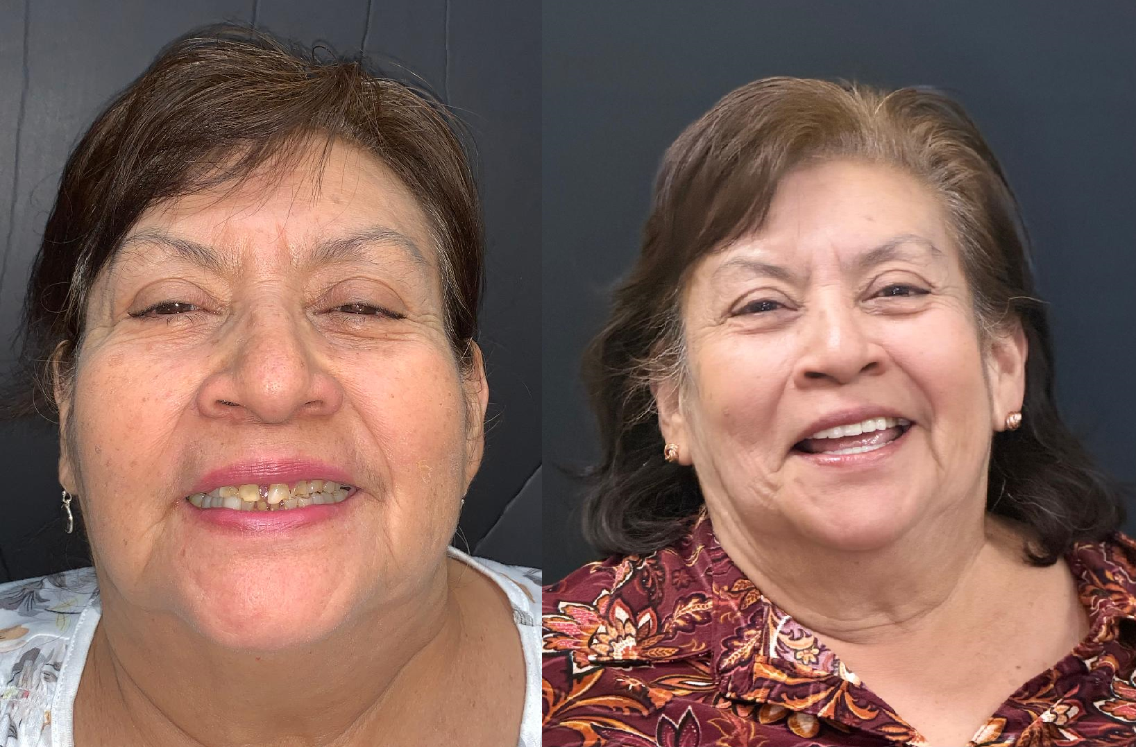 Patient smile result