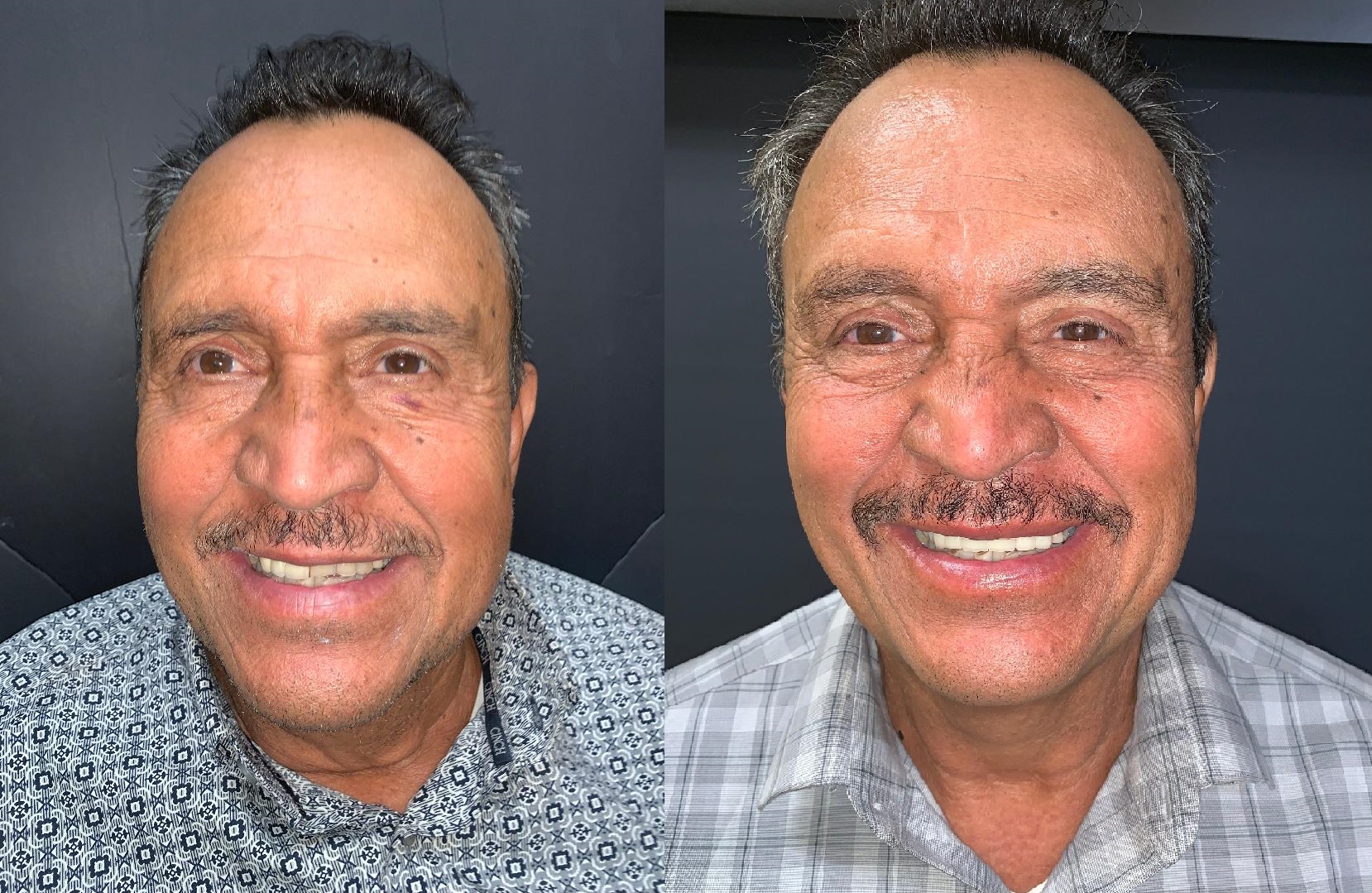 Patient smile result