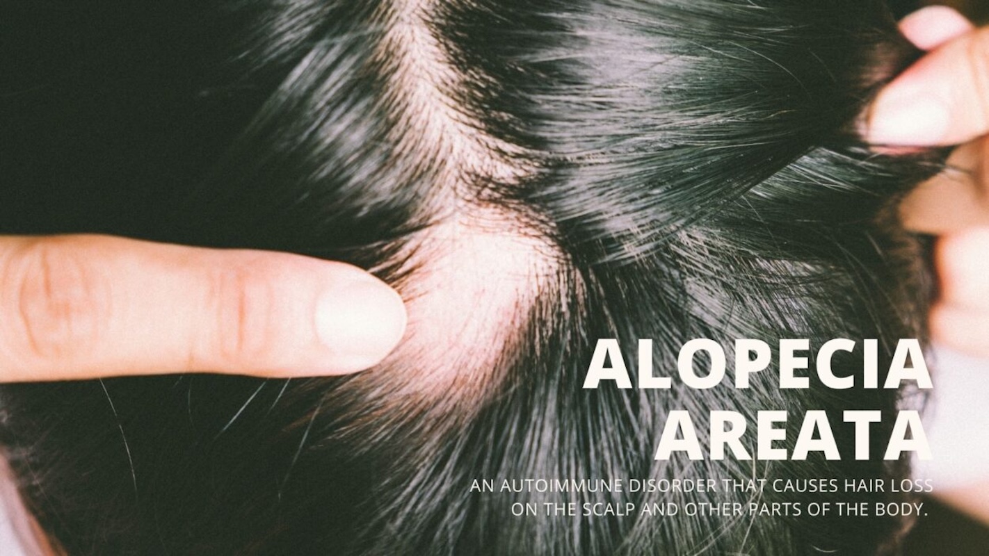Alopecia Areata Alopecia Areata