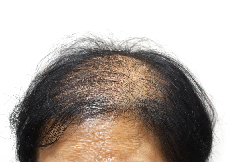 alopecia-androgenetic alopecia-androgenetic