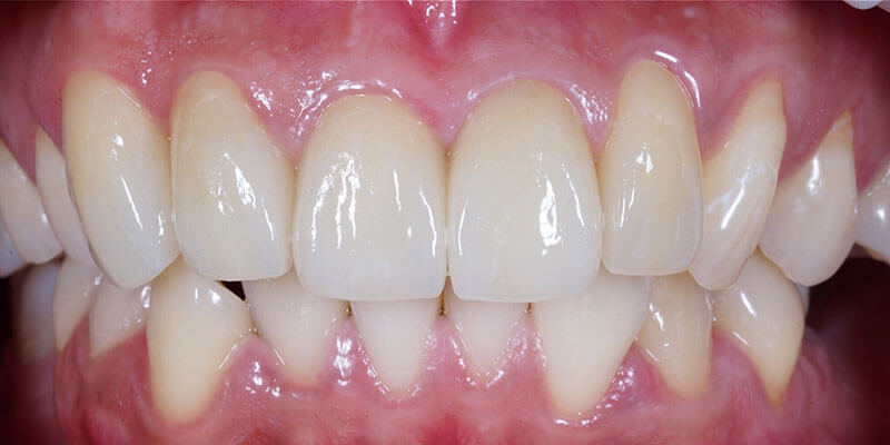 Patient smile after dental implant treatment