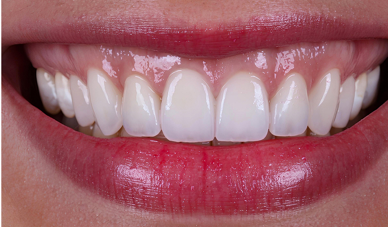 Patient smile after dental implant treatment