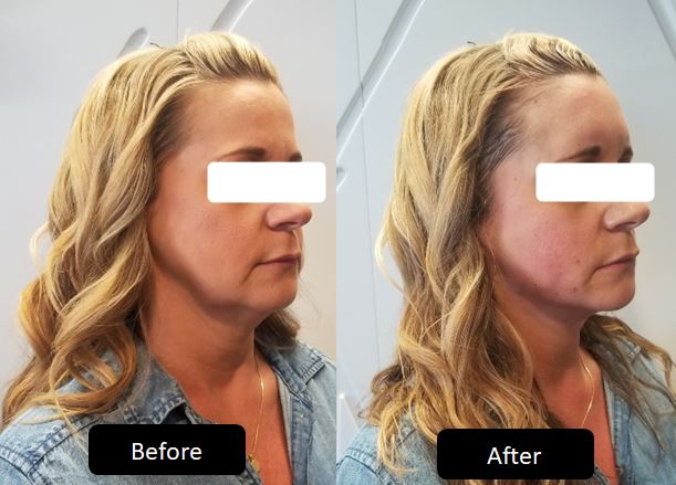 Before and after PDO thread lift, side profile