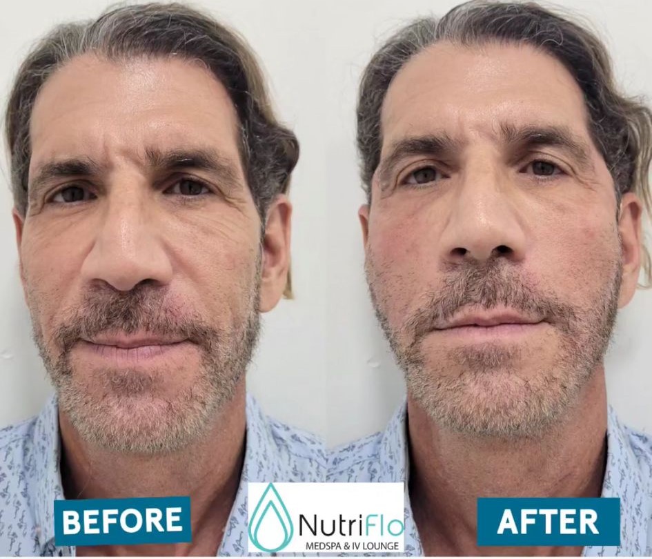 Before and after PDO thread lift, jawline