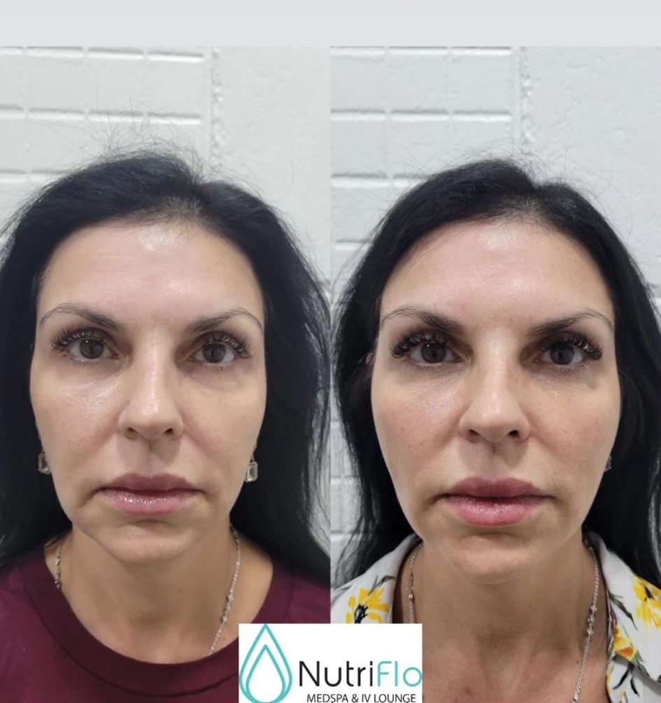 Before and after PDO thread lift, midface