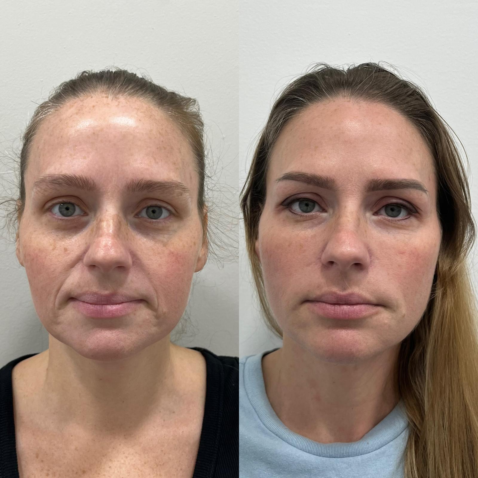 Before and after PDO thread lift, full face
