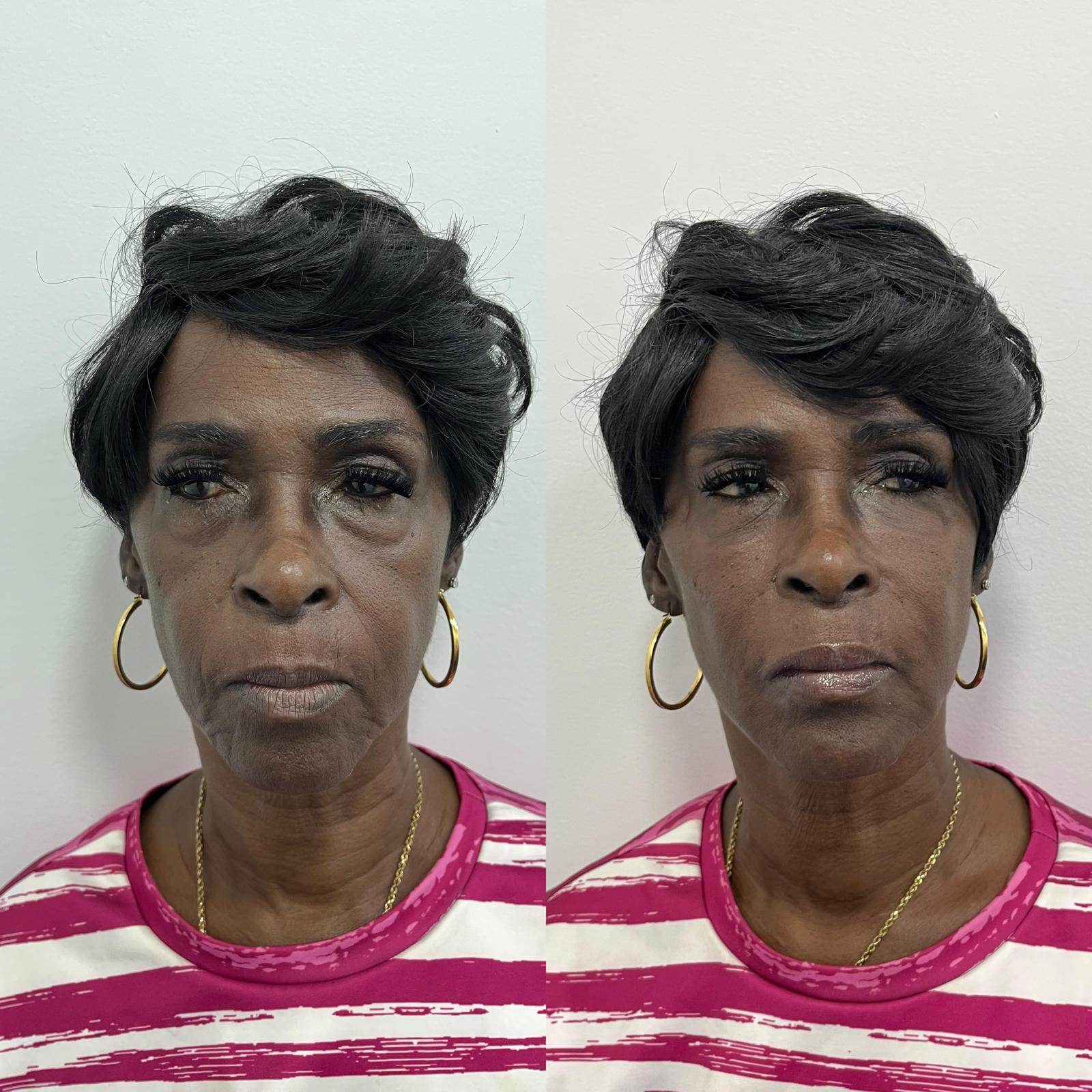 Before and after PDO thread lift result on a NutriFlo patient