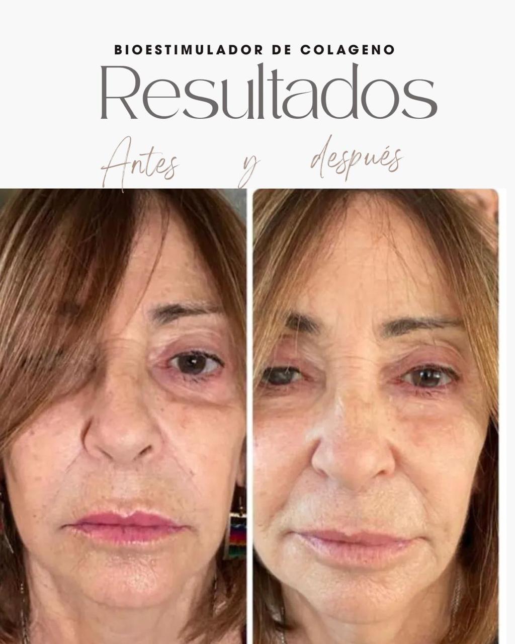 Resultado real del Sistema RESET 4