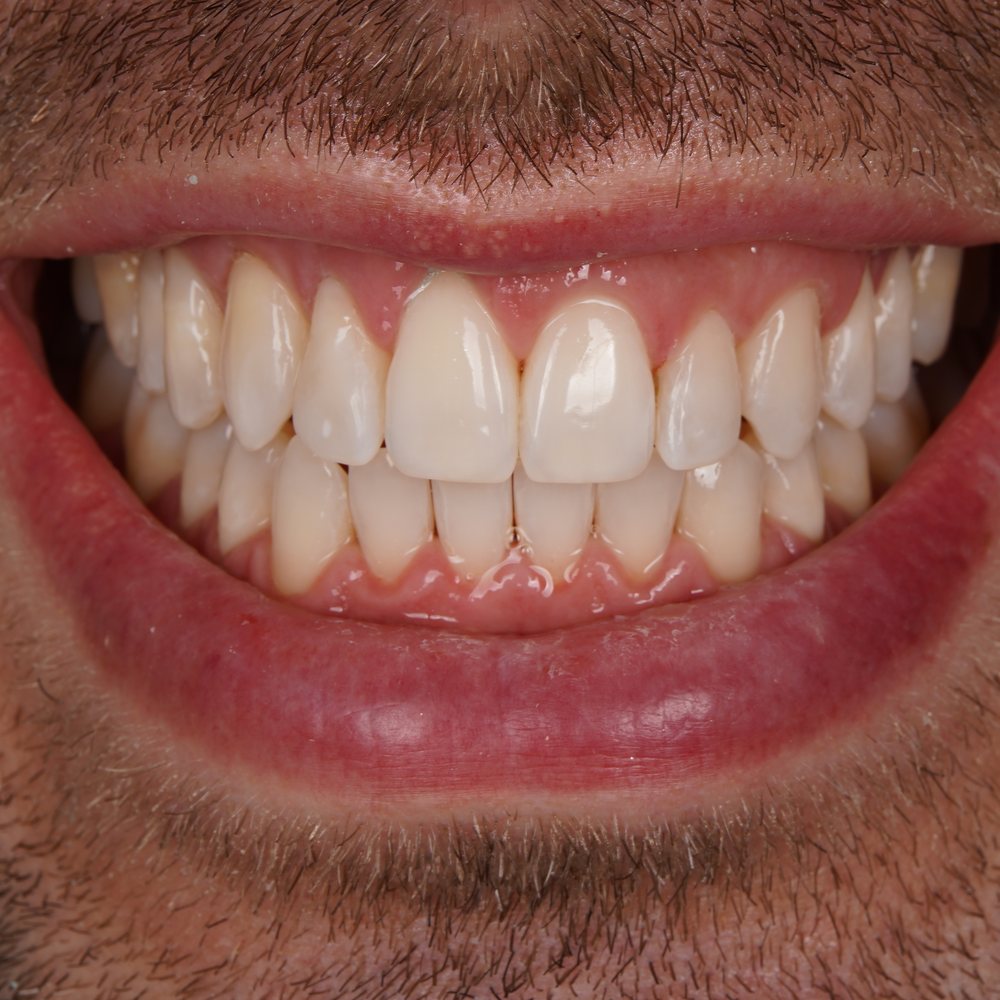 Pacijent nakon Invisalign terapije