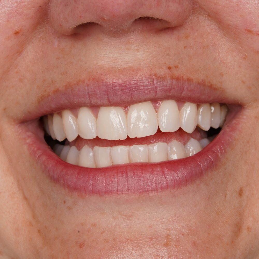 Pacijentica nakon Invisalign terapije