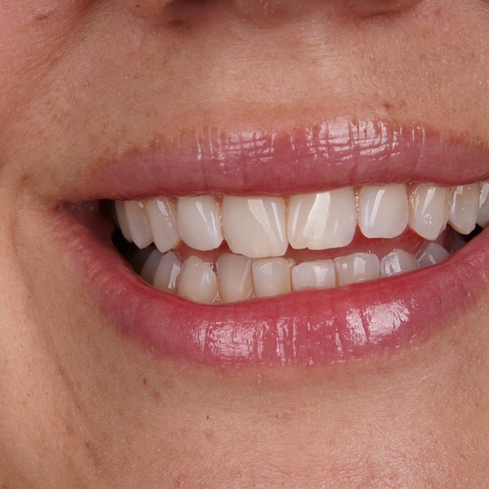 Pacijentica prije Invisalign terapije