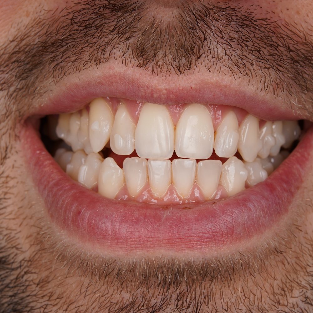 Pacijent prije Invisalign terapije