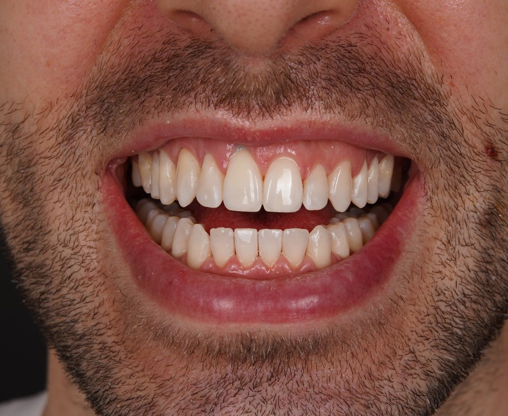 Osmijeh pacijenta nakon završene Invisalign terapije