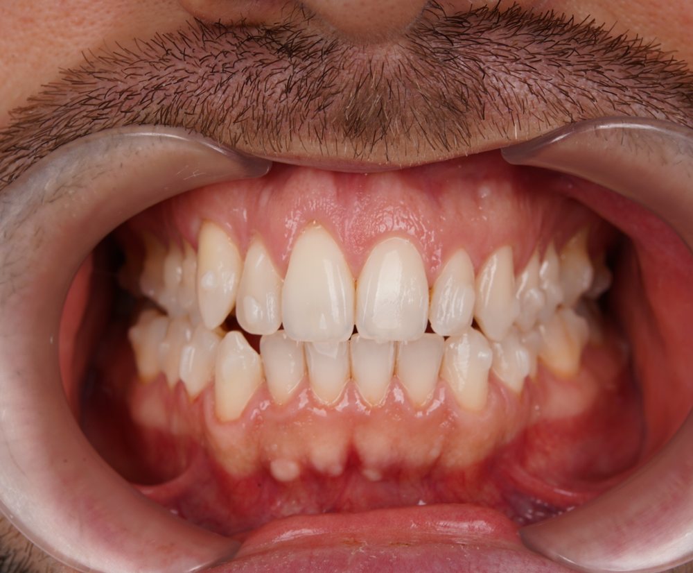 Klinička fotografija zagriza prije Invisalign terapije