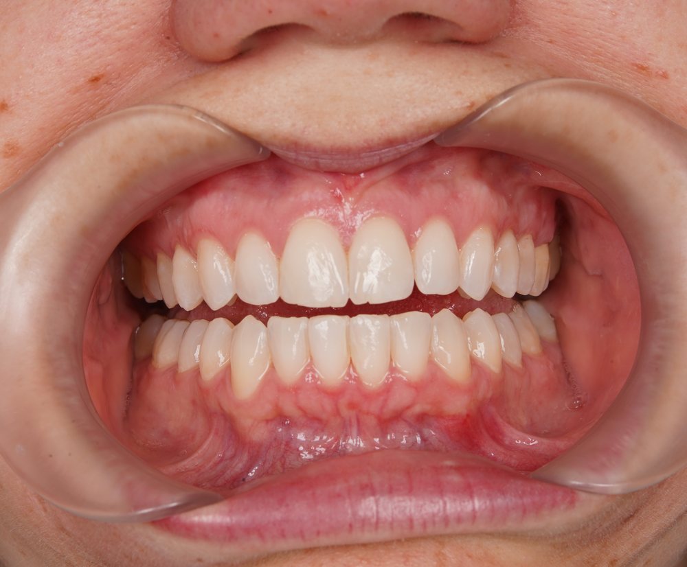 Klinička fotografija zagriza nakon Invisalign terapije