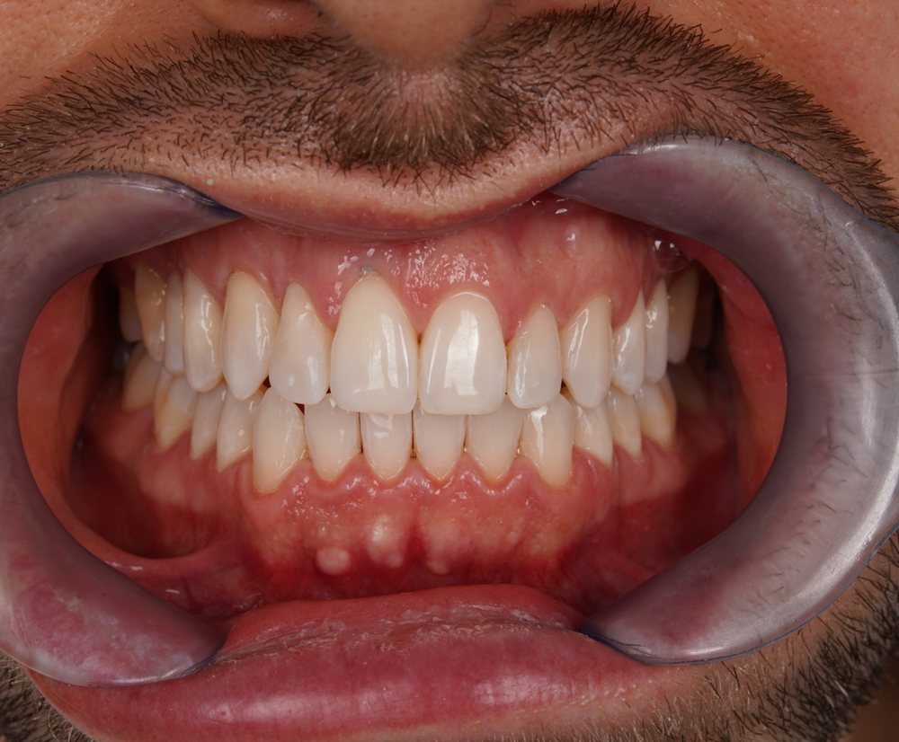 Klinička fotografija zagriza nakon Invisalign terapije