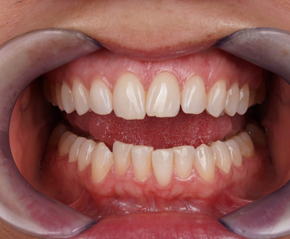 Klinička fotografija zagriza prije Invisalign terapije