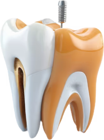 diagram of tooth receiving dental work