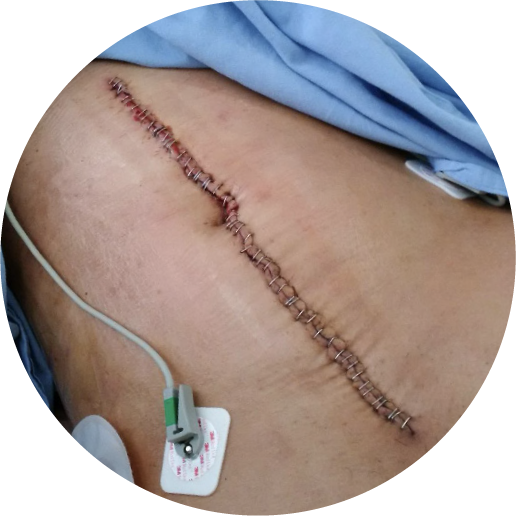 Fascia Closure