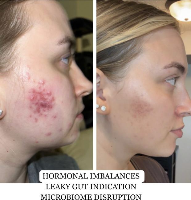 Client before and after, hormonally driven cystic acne on the cheek and jaw