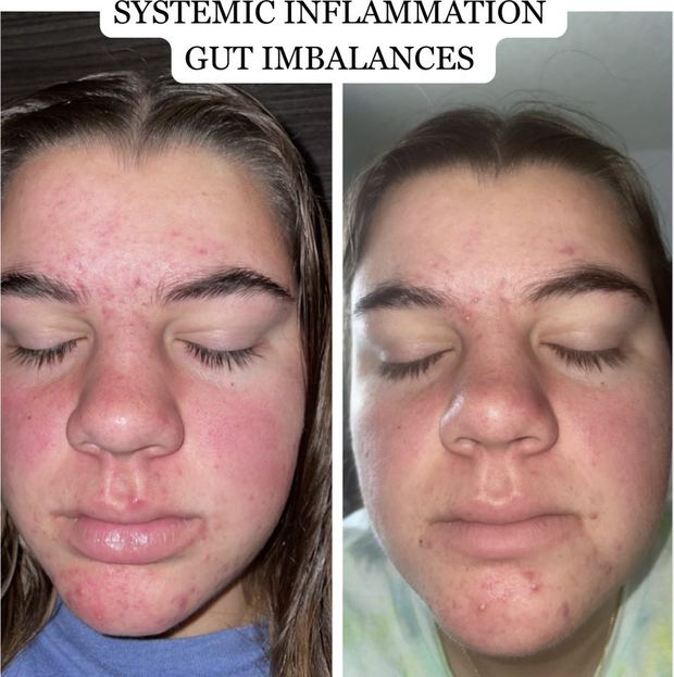 Client before and after, adult inflammatory acne and facial redness calmed