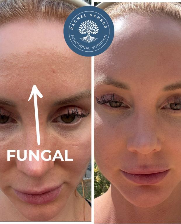 Client before and after, fungal folliculitis on the forehead cleared
