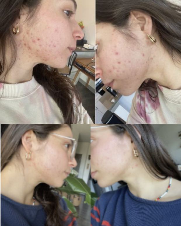 Client before and after, jawline and lower cheek acne, the classic androgen pattern
