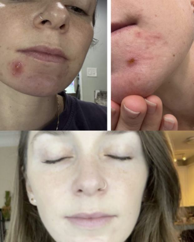 Client before and after, a cystic lesion on the chin resolved to clear skin