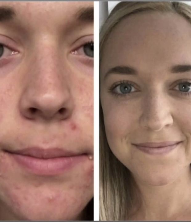 Client before and after, congested and textured skin resolved to clear skin