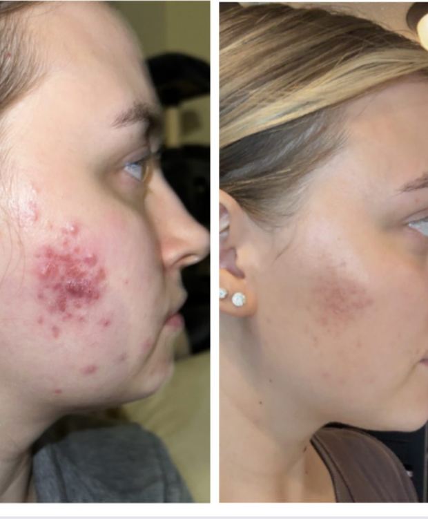 Client before and after, severe cystic acne on the cheek substantially resolved